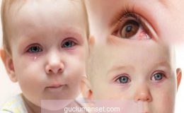 Bebeklerin gözleri neden kanlanır? Yeni doğan bebekte göz kanlanması nasıl geçer?